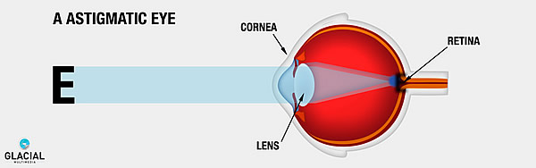 Astigmatism